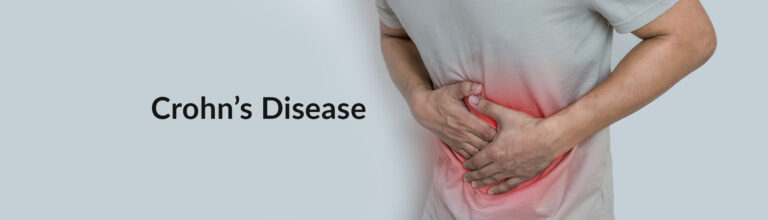 Crohn’s Disease | 5 Ayurvedic Clinic in Delhi | Sushruta Clinic